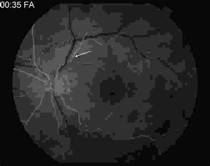 Angio OCT Image Of The Retinal Vasculature Angio OCT In Everyday Ophthalmic Practice