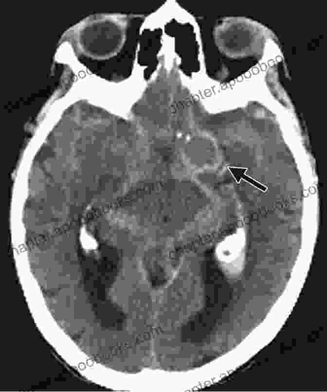 CT Scan Of A Brain With An Aneurysm Case Based Interventional Neuroradiology Timo Krings