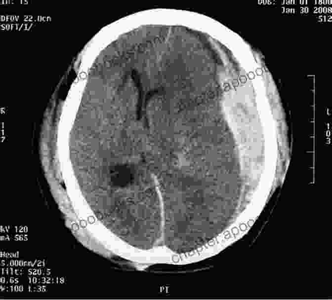 CT Scan Of A Subdural Hematoma Subdural Hematoma: Past To Present To Future Management