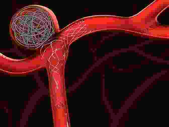 Endovascular Coiling Of An Aneurysm Case Based Interventional Neuroradiology Timo Krings