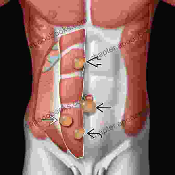 Illustration Of A Hernia With Bulging Tissue Homeopathic Medicines For HERNIA : Homeo Remedies Healing With Homeopathy