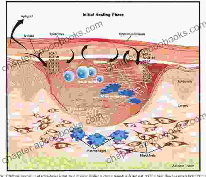 Nanotechnology Based Approaches For Preventing Skin Infections, Such As Wound Dressings Infused With Antimicrobial Nanoparticles Nanotechnology In Skin Soft Tissue And Bone Infections