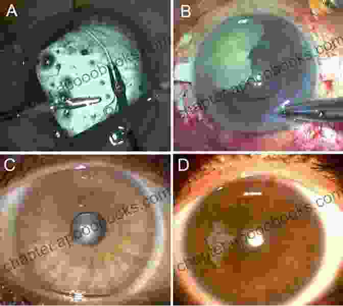 Posterior Segment Complications of Cataract Surgery