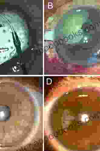 Posterior Segment Complications Of Cataract Surgery