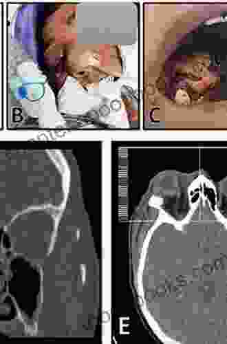 Rhino Orbito Cerebral Mucormycosis Tessa Bailey