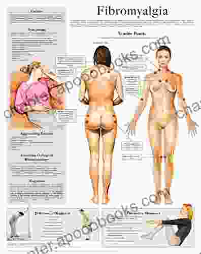 Fibromyalgia E Chart: Full Illustrated